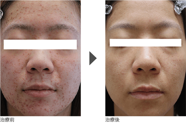 額(おでこ)、こめかみ、頬、顎(あご)、顎裏にかけての  ニキビ治療 20代半ば 女性