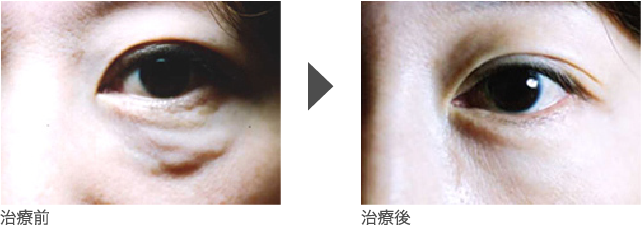 目の下のヒアルロン酸分解治療  女性