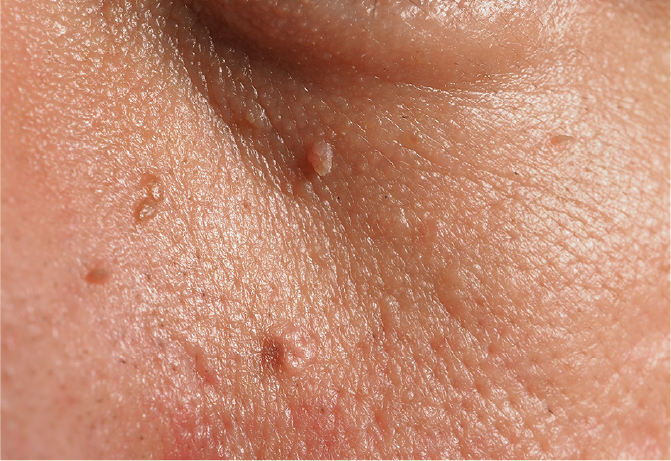 手のニキビを自然に治療する