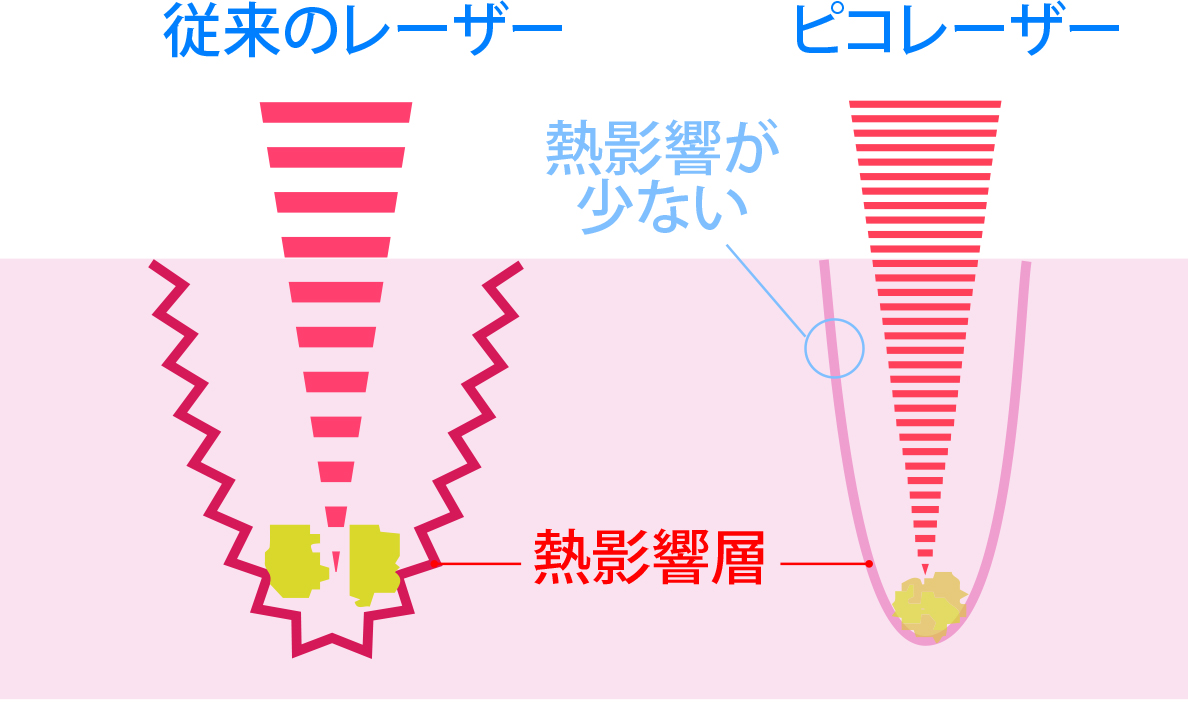 従来のレーザーとピコレーザー
