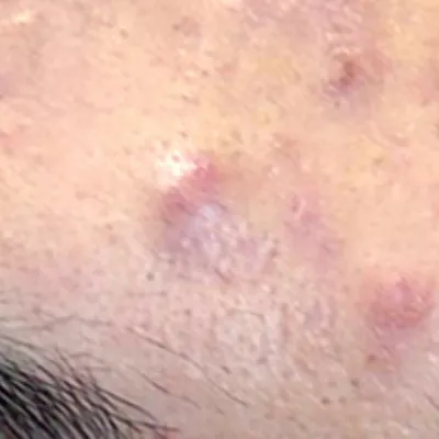 しこりニキビとは？