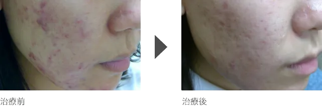 ニキビ治療 20代女性