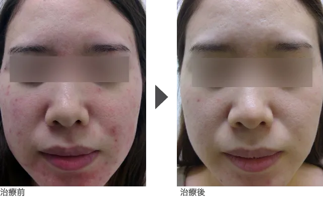 ニキビ治療 20代女性