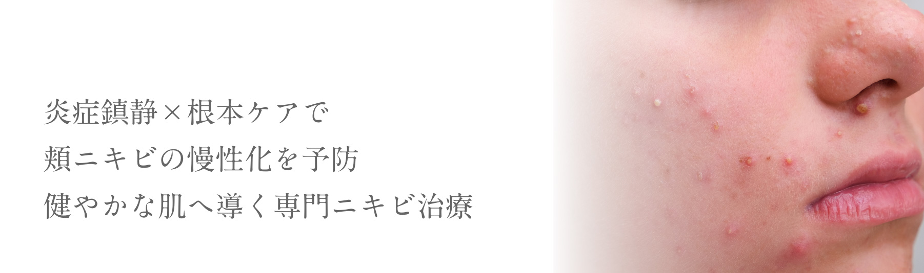 炎症鎮静×根本ケアで頬ニキビの慢性化を予防健やかな肌へ導く専門ニキビ治療