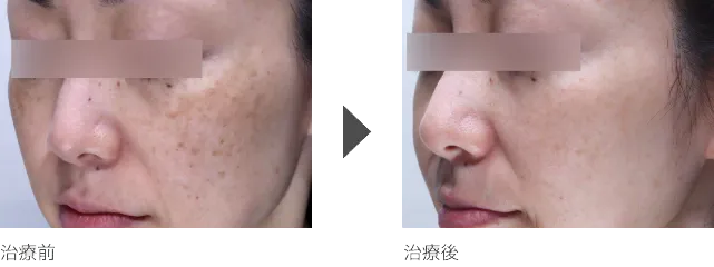 シミ・くすみ治療 40代女性