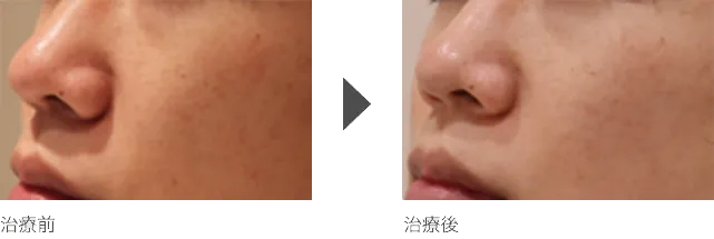頬の毛穴治療 30代男性