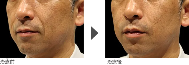 ほうれい線のしわ治療 50代男性