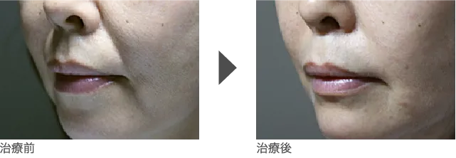口元のしわ治療 40代女性