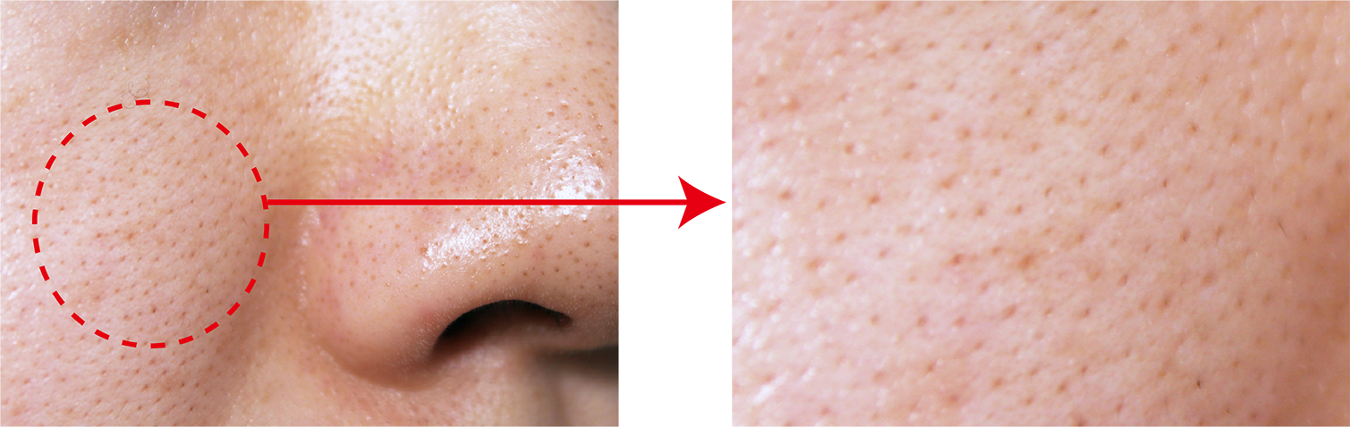 黒ずみ毛穴（産毛）