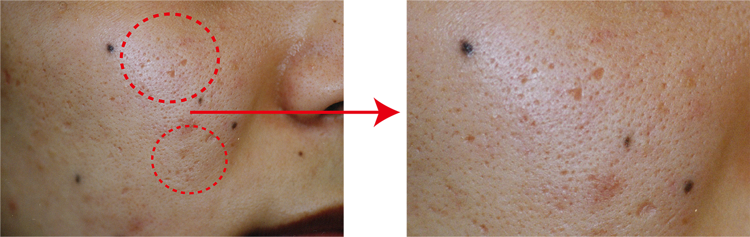 クレーター毛穴