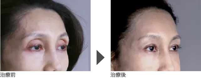 こめかみのヒアルロン酸注入（注射）の症例 50代女性