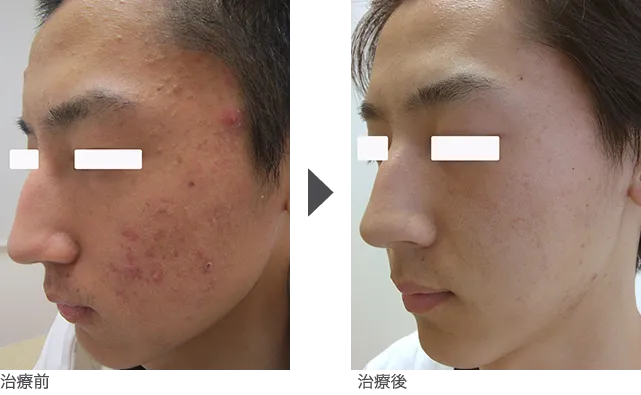 額（おでこ）、こめかみ、頬のニキビ治療　10代後半　男性